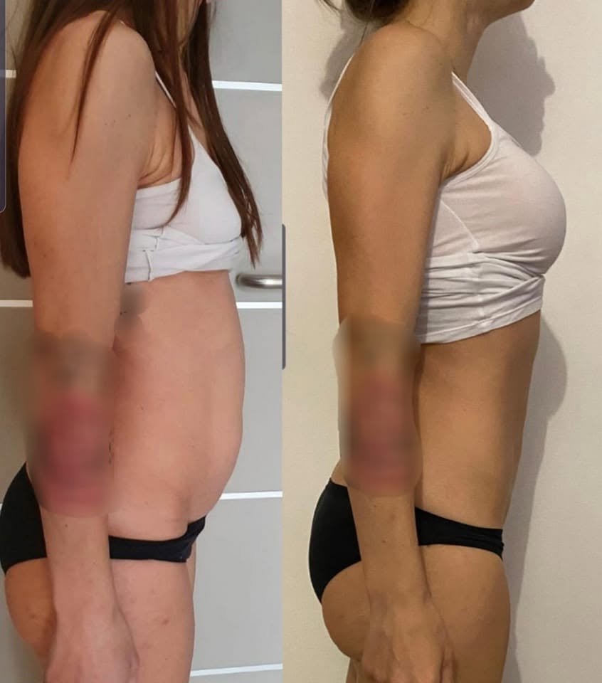 pre e post intervento di chirurgia mininvasiva con tecnica Tesar per diastasi addominale 