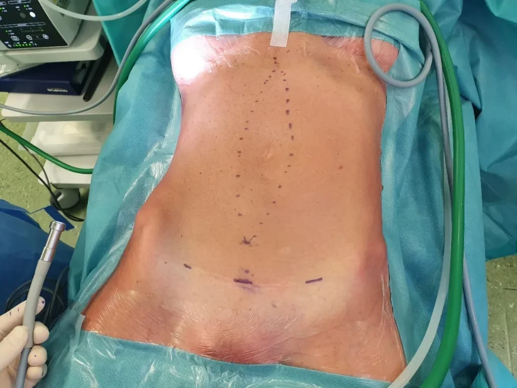 tecnica chirurgica Tesar. Marcatura pre-operatoria